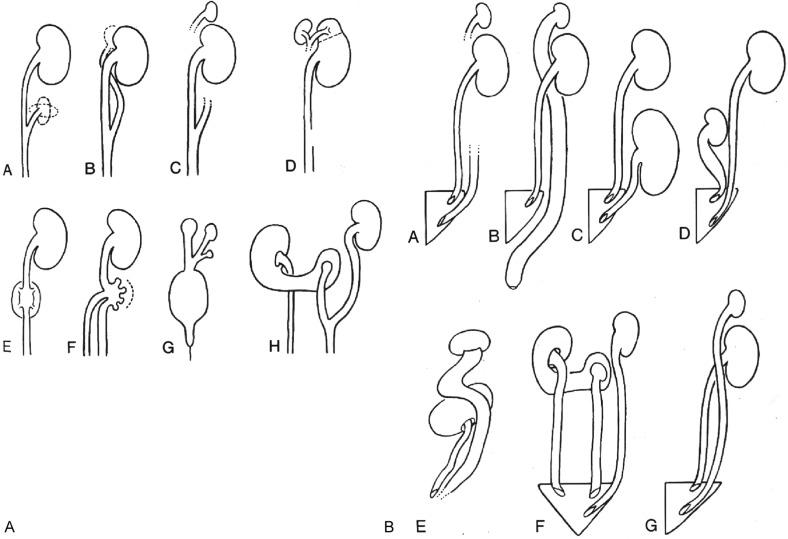 Fig. 1.30, Morphologic variants of supernumerary kidneys with bifid ureters (A) and separate ureters (B).