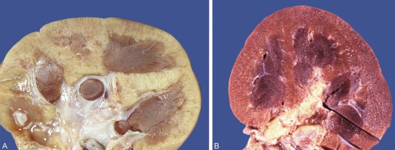 Fig. 1.31, (A) This 3-cm hypoplastic kidney was from a 2-year-old child with a contralateral duplex kidney. It appears to have only five lobes. (B) This 5.5-cm hypoplastic kidney was from an adult with a 13.5-cm hypertrophic contralateral kidney.