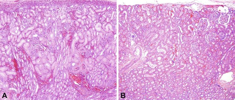 Fig. 1.33, (A) Cortical hypoplasia in a newborn kidney. Two medullary rays are visible. The renal medulla is at the bottom, and the renal capsule is at the top . Only three or four nephron generations are present. (B) This is an adult kidney with cortical hypoplasia. The medulla is at the bottom, and the renal capsule is at the top . Only two or three nephron generations are present.