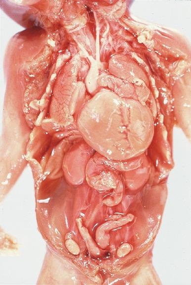 Fig. 1.36, This is the third consecutive fetus affected with bilateral renal-ureteral agenesis in a family with familial renal adysplasia. The small and large bowels have been removed to reveal the adrenal glands. Both kidneys are absent.