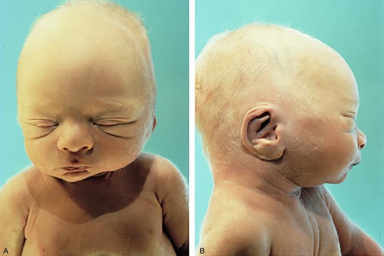 Fig. 1.37, An infant born with oligohydramnios and the characteristic Potter facies in anterior (A) and lateral (B) views.