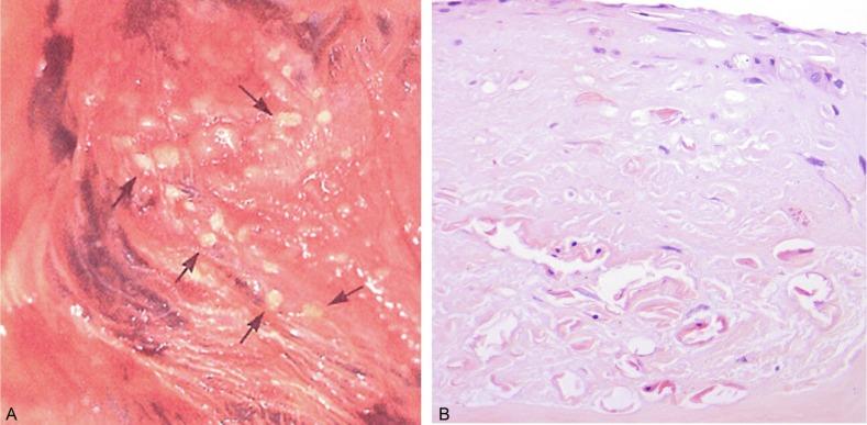 Fig. 1.38, (A) Placenta with plaques of amnion nodosum ( arrows ). (B) Plaques of amnion nodosum contain clumps of fetal squames embedded in dense collagen.