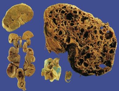 Fig. 1.39, Autosomal recessive polycystic kidney ( upper left ), autosomal dominant polycystic kidney (upper right), and three forms of renal dysplasia: aplastic dysplasia from a 35-year-old patient, multicystic dysplasia from a neonate, and bilateral dysplasia associated with lower tract obstruction ( lower left ).