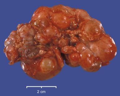 Fig. 1.40, This is the external appearance of a typical multicystic dysplastic kidney. It is markedly enlarged and diffusely cystic with cysts of variable size.