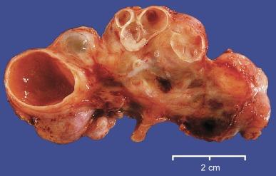 Fig. 1.41, Transverse section of a typical multicystic dysplastic kidney.