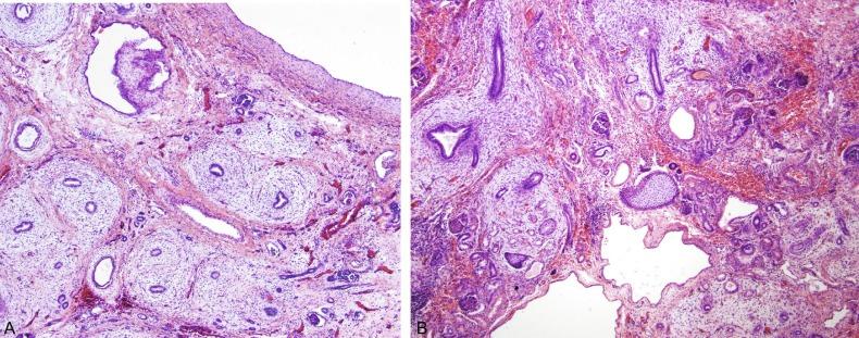 Fig. 1.43, (A) This dysplastic kidney contains large cysts and numerous dysplastic tubules with collarettes of spindle cells. (B) This dysplastic kidney contains numerous dysplastic tubules with collarettes of spindle cells and an island of immature cartilage in the center.