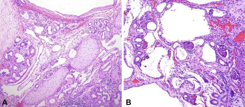 Fig. 1.44, (A) Renal dysplasia showing a portion of a cyst with several islands of immature cartilage, scattered tubules, and abnormally formed glomeruli. (B) This dysplastic kidney has microcysts (at least one is a glomerular cyst), small tubules, and atubular glomeruli.