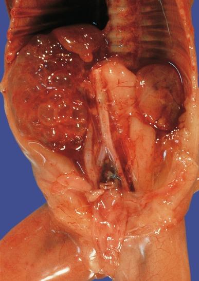 Fig. 1.47, Hereditary renal adysplasia with unilateral multicystic dysplasia and contralateral renal agenesis shown in situ.