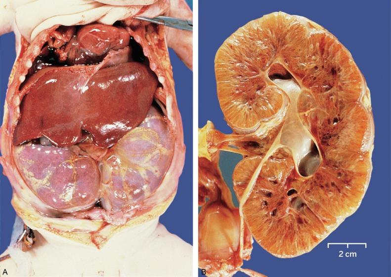 Fig. 1.48, (A) Autosomal recessive polycystic kidney disease showing massive kidneys that distend the abdomen, elevate the diaphragm, and compromise the thoracic cavity. (B) The bivalved kidney has a reniform shape and a normal collecting system. The cortex and medulla contain diffuse, relatively uniform cysts.