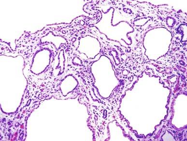 Fig. 1.50, The medullary cysts in autosomal recessive polycystic kidney disease are also lined with uniform cuboidal epithelium.