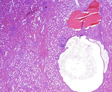 Fig. 1.53, Infantile onset of autosomal dominant polycystic kidney disease at age 7 years with a largely intact cortex and several cysts.