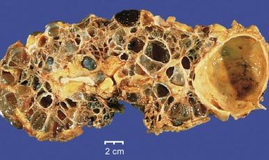 Fig. 1.54, Transverse section of an advanced-stage autosomal dominant polycystic kidney disease kidney. Both the cortex and the medulla are replaced by cysts.