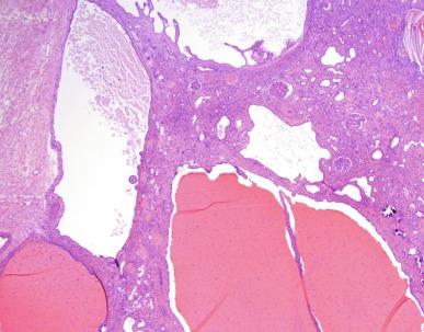 Fig. 1.55, Advanced autosomal dominant polycystic kidney disease from an adult with chronic renal failure shows severe interstitial scarring with calcifications and cysts that contain proteinaceous fluid.