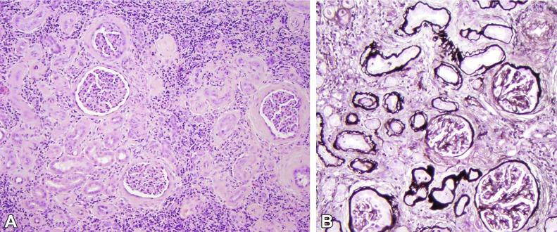 Fig. 1.58, (A) Nephronophthisis showing a chronic interstitial nephritis. Although there is periglomerular fibrosis the glomeruli otherwise are intact, associated with severe chronic tubulointerstitial injury. (B) The atrophic tubules typically show basement membrane multilayering (Jones methenamine silver stain).