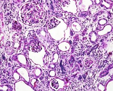 Fig. 1.59, This infantile form of nephronophthisis also shows chronic interstitial nephritis. Glomerular microcysts are visible, and the atrophic tubules lack basement membrane multilayering (periodic acid–Schiff stain.)