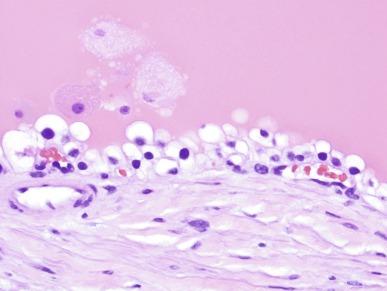 Fig. 1.62, Cyst in von Hippel–Lindau disease is lined with low nuclear grade clear cells.