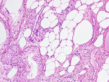 Fig. 12.102, Adult cryptorchid testis showing metaplastic fat cells between the seminiferous tubules and the rete testis.