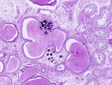 Fig. 12.103, Intratesticular mesonephric remnants.