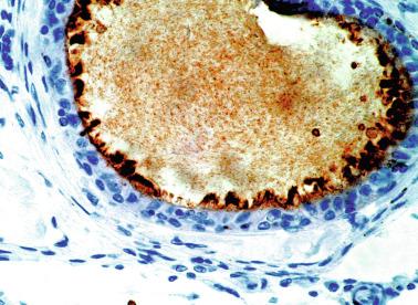 Fig. 12.105, Ectopic epididymal-like formation showing positive CD10 expression in adluminal border and stereocilia.