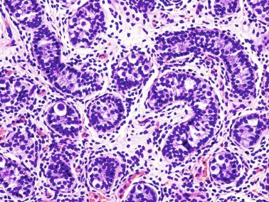 Fig. 12.106, Cryptorchidism.