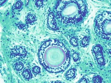 Fig. 12.109, Microlithiasis in an infant cryptorchid testis.