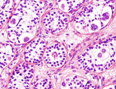 Fig. 12.112, Prepubertal cryptorchid testis.