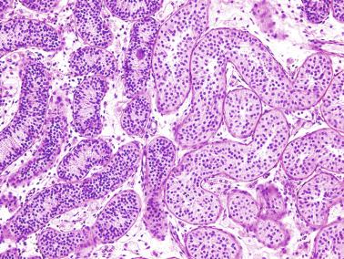 Fig. 12.113, Pubertal cryptorchidism.