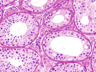 Fig. 12.115, Adult ex-cryptorchid testis that was surgically descended at the age of 2 years. Tubular sections show a pattern varying from spermatogonial maturation arrest to complete, although decreased, spermatogenesis.