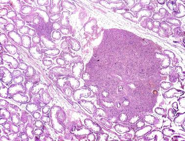 Fig. 12.117, Nodular Leydig cell hyperplasia in an adult ex-cryptorchid testis.