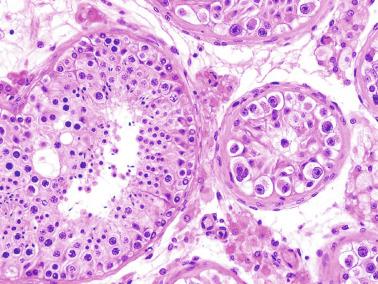 Fig. 12.123, Adult ex-cryptorchid testis that was surgically descended at infancy. The patient was infertile. The smallest seminiferous tubule shows intratubular germ cell neoplasia, undifferentiated type. The relative tumor cell homogeneity contrasts with the variety in shape and size of the cells in the adjacent seminiferous tubule with complete spermatogenesis.