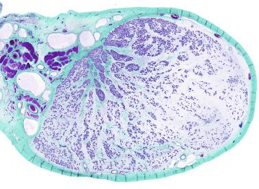 Fig. 12.125, Testicular atrophy in a child after descent done 3 years earlier. The most affected parenchyma is the peripherally situated parenchyma in which the seminiferous tubules are barely distinguished in the testicular stroma.