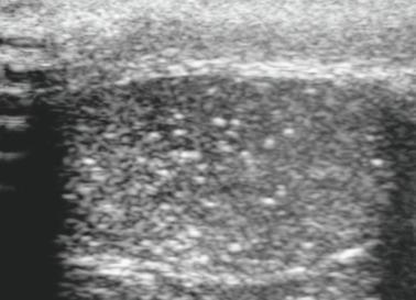 Fig. 12.127, Testicular microlithiasis showing the characteristic “snowstorm” pattern.