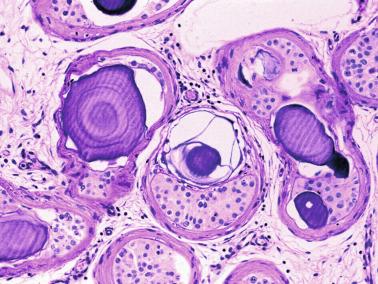 Fig. 12.128, Extratubular and intratubular microliths in an adult testis with isolated spermatogonia and Sertoli cells.