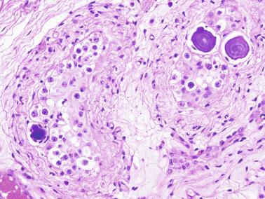 Fig. 12.131, Seminiferous tubules containing both GCNIS and microliths in the periphery of a seminoma.