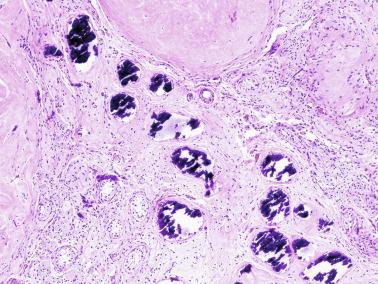 Fig. 12.132, Testicular parenchyma with fibrosis of a burned-out tumor next to intratubular calcifications of an intratubular germ cell neoplasia.