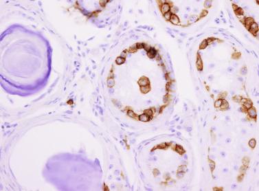 Fig. 12.133, Microlithiasis associated with germ cell neoplasia in situ. Immunostaining for placental alkaline phosphatase.