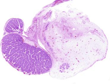 Fig. 12.14, Panoramic view of testis, epididymis, and gubernaculum of a 34-week gestation newborn. The size of the gubernaculum exceeds that of the testis and epididymis combined.