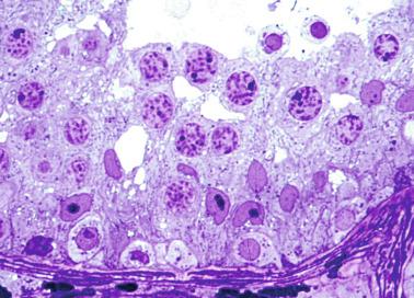 Fig. 12.30, Germ cell development progresses from the basal lamina toward the lumen of the tubule. Each germ cell type forms a different layer in the seminiferous tubules and may be identified by its nuclei. Spermatogonia are basal cells with pale cytoplasm, round nuclei, and eccentric nucleoli. Above these cells, the Sertoli cell nuclei may be recognized by their large central nucleoli. The inner layers consist of primary spermatocytes showing the chromatin pattern characteristic of meiosis (semithin section).