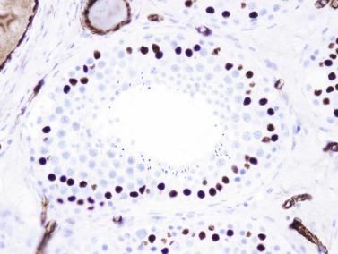 Fig. 12.31, Cross section of a seminiferous tubule. Immunostaining in the nuclei of Sertoli cells and in endothelial cells with the WT1 antibody is observed.