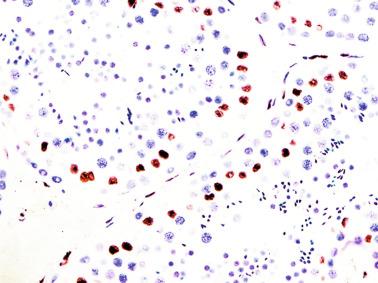 Fig. 12.32, Sertoli cells and peritubular myoid cells show immunoexpression of androgen receptor in the nuclei.