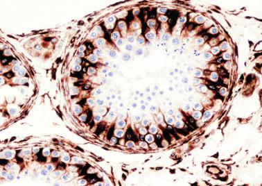 Fig. 12.33, Cross section of seminiferous tubule showing Sertoli cells that are intensely immunoreactive for vimentin. Positive staining is also observed in peritubular and endothelial cells.