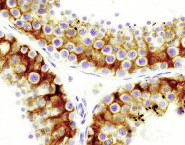 Fig. 12.34, Cross section of part of three seminiferous tubules showing intense immunoreactivity for inhibin in the cytoplasm of Sertoli cells.