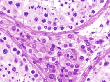 Fig. 12.35, Leydig cells may be observed in the space among three seminiferous tubules. Seminiferous tubules show numerous type A spermatogonia in the center and type B spermatogonia in the peripheral areas.