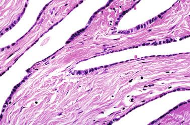 Fig. 12.42, Rete testis showing cavities lined by flat squamous epithelium interspersed with small groups of columnar cells, which are usually located in angles. Connective tissue among cavities is dense.