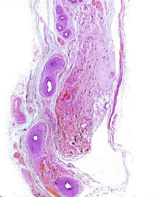 Fig. 12.44, Spermatic cord in anorchidism.