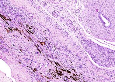 Fig. 12.46, Next to the vas deferens, fibrous tissue with numerous macrophages with hemosiderin may be observed where the testis should have been.