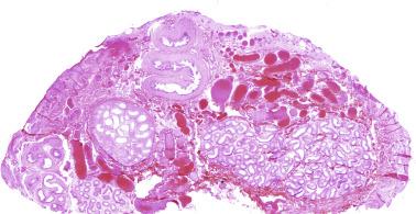 Fig. 12.47, Vanishing testis in an adult.