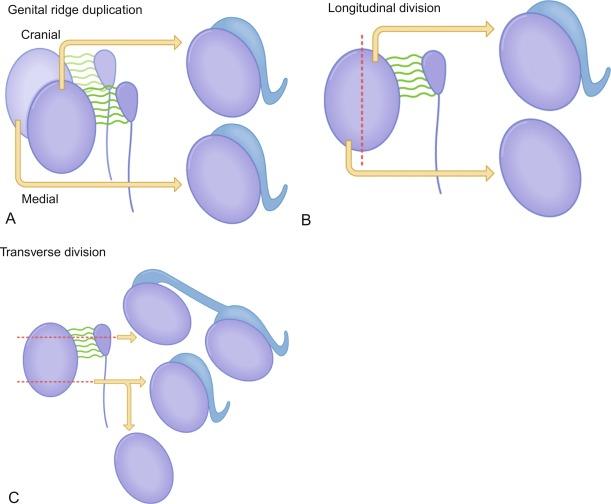 Fig. 12.49, Possible mechanisms of polyorchidism.