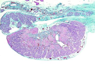 Fig. 12.51, Congenital Leydig cell hyperplasia.