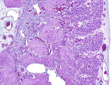 Fig. 12.52, Congenital nodular hyperplasia of Leydig cells.